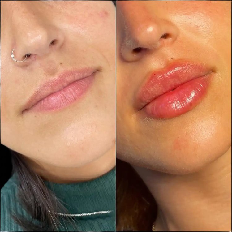 How the Best Doctors in dubai Customize Juvederm Treatments for Every Patient